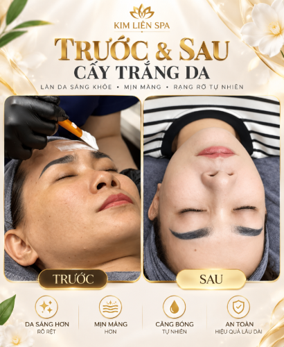 CẤY TRẮNG DA TẠI SPA KIM LIÊN